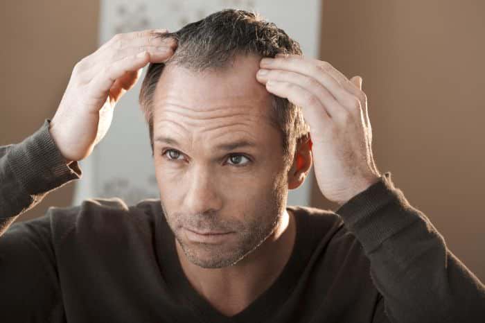 How To Manage Balding Hair - 1